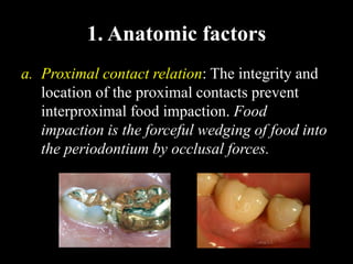 1. Anatomic factors
a. Proximal contact relation: The integrity and
location of the proximal contacts prevent
interproximal food impaction. Food
impaction is the forceful wedging of food into
the periodontium by occlusal forces.
 