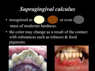 Supragingival calculus
• recognized as , or even
mass of moderate hardness.
• the color may change as a result of the contact
with substances such as tobacco & food
pigments.
 
