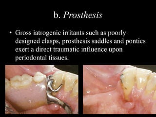 b. Prosthesis
• Gross iatrogenic irritants such as poorly
designed clasps, prosthesis saddles and pontics
exert a direct traumatic influence upon
periodontal tissues.
 