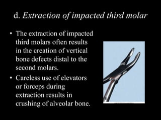 d. Extraction of impacted third molar
• The extraction of impacted
third molars often results
in the creation of vertical
bone defects distal to the
second molars.
• Careless use of elevators
or forceps during
extraction results in
crushing of alveolar bone.
 