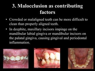 3. Malocclusion as contributing
factors
• Crowded or malaligned teeth can be more difficult to
clean than properly aligned teeth.
• In deepbite, maxillary incisors impinge on the
mandibular labial gingiva or mandibular incisors on
the palatal gingiva, causing gingival and periodontal
inflammation.
 