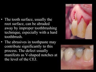 • The tooth surface, usually the
root surface, can be abraded
away by improper toothbrushing
technique, especially with a hard
toothbrush.
• The abrasives in toothpaste may
contribute significantly to this
process. The defect usually
manifests as V-shaped notches at
the level of the CEJ.
 