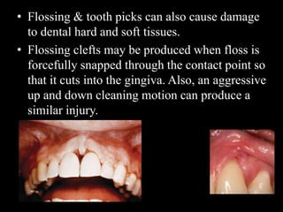 • Flossing & tooth picks can also cause damage
to dental hard and soft tissues.
• Flossing clefts may be produced when floss is
forcefully snapped through the contact point so
that it cuts into the gingiva. Also, an aggressive
up and down cleaning motion can produce a
similar injury.
 