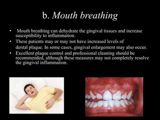 b. Mouth breathing
• Mouth breathing can dehydrate the gingival tissues and increase
susceptibility to inflammation.
• These patients may or may not have increased levels of
dental plaque. In some cases, gingival enlargement may also occur.
• Excellent plaque control and professional cleaning should be
recommended, although these measures may not completely resolve
the gingival inflammation.
 