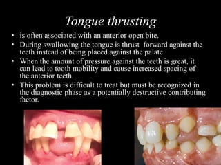 Tongue thrusting
• is often associated with an anterior open bite.
• During swallowing the tongue is thrust forward against the
teeth instead of being placed against the palate.
• When the amount of pressure against the teeth is great, it
can lead to tooth mobility and cause increased spacing of
the anterior teeth.
• This problem is difficult to treat but must be recognized in
the diagnostic phase as a potentially destructive contributing
factor.
 