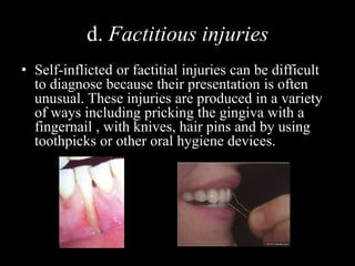 d. Factitious injuries
• Self-inflicted or factitial injuries can be difficult
to diagnose because their presentation is often
unusual. These injuries are produced in a variety
of ways including pricking the gingiva with a
fingernail , with knives, hair pins and by using
toothpicks or other oral hygiene devices.
 