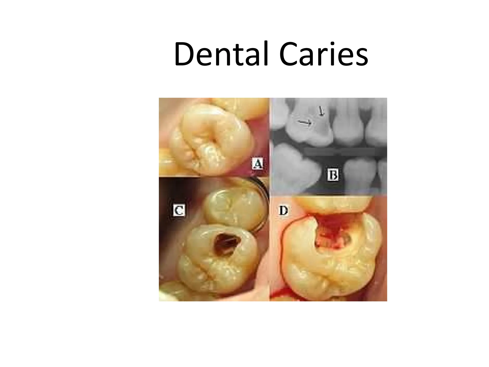 Oral pathology chapter 6 Dental caries.pptx