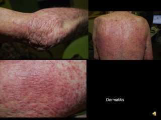 6. dermatitis and its variants | PPT
