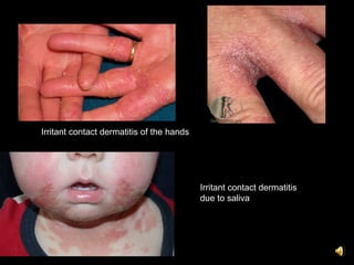 6. dermatitis and its variants | PPT