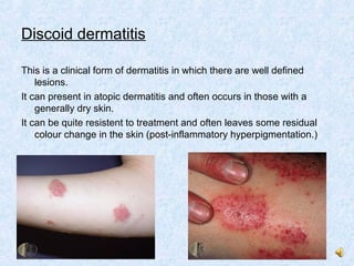 6. dermatitis and its variants | PPT