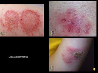 6. dermatitis and its variants | PPT