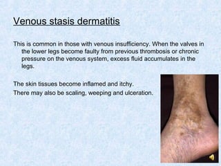 6. dermatitis and its variants | PPT