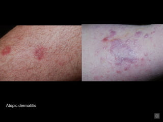6. dermatitis and its variants | PPT
