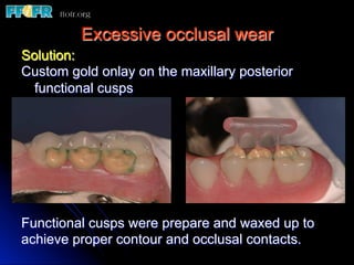 Excessive occlusal wear
Solution:
Custom gold onlay on the maxillary posterior
  functional cusps




Functional cusps were prepare and waxed up to
achieve proper contour and occlusal contacts.
 