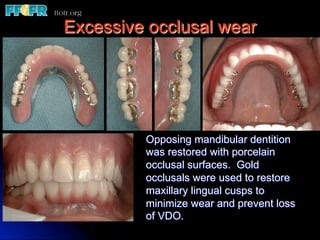 Excessive occlusal wear




         Opposing mandibular dentition
         was restored with porcelain
         occlusal surfaces. Gold
         occlusals were used to restore
         maxillary lingual cusps to
         minimize wear and prevent loss
         of VDO.
 