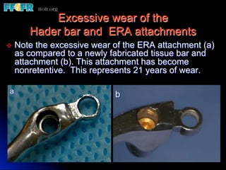Excessive wear of the
        Hader bar and ERA attachments
v  Note  the excessive wear of the ERA attachment (a)
     as compared to a newly fabricated tissue bar and
     attachment (b). This attachment has become
     nonretentive. This represents 21 years of wear.

 a                           b
 