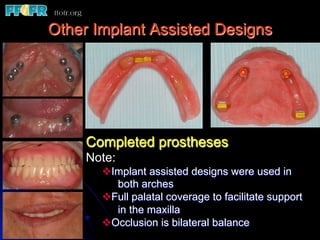 Other Implant Assisted Designs




     Completed prostheses
     Note:
       v Implant assisted designs were used in
           both arches
       v Full palatal coverage to facilitate support
           in the maxilla
       v Occlusion is bilateral balance
 