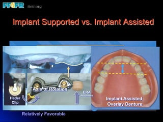 Implant Supported vs. Implant Assisted



                                           The distance
        Factors Determining                between the
        Implant Supported vs. Assisted-AP of the
                                           center Spread
                                          most anterior
        4 Implant Assisted Overlay Denture
                             VS.         implant and the
        4 Implant Rotation”
           “Axis of Bar Design-Axis distal of the most
                                ERA
                                         of Rotation
Hader
                              Attachment
                                         posterior implant
                                            Implant Assisted
 Clip
                                            Overlay Denture

        Relatively Favorable
 