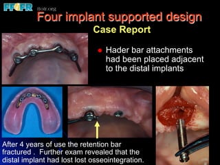 Four implant supported design
                             Case Report

                              l    Hader bar attachments
                                    had been placed adjacent
                                    to the distal implants




After 4 years of use the retention bar
fractured . Further exam revealed that the
distal implant had lost lost osseointegration.
 