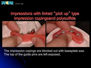 Impressions with linked “pick up” type
      impression copingsand polysulfide




The impression copings are blocked out with baseplate wax.
The top of the guide pins are left exposed,
 