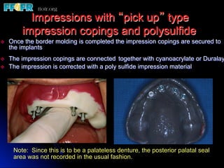 Impressions with “pick up” type
          impression copings and polysulfide
v    Once the border molding is completed the impression copings are secured to
      the implants
v    The impression copings are connected together with cyanoacrylate or Duralay
v    The impression is corrected with a poly sulfide impression material




       Note: Since this is to be a palateless denture, the posterior palatal seal
       area was not recorded in the usual fashion.
 