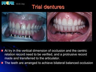 Trial dentures




! At try in the vertical dimension of occlusion and the centric
  relation record need to be verified, and a protrusive record
  made and transferred to the articulator.
! The teeth are arranged to achieve bilateral balanced occlusion
 
