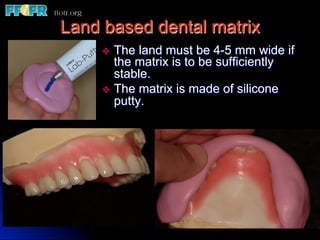 Land based dental matrix
     v  The  land must be 4-5 mm wide if
         the matrix is to be sufficiently
         stable.
     v  The matrix is made of silicone
         putty.
 