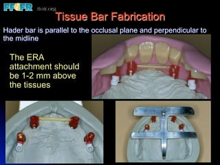 Tissue Bar Fabrication
Hader bar is parallel to the occlusal plane and perpendicular to
the midline

  The ERA
  attachment should
  be 1-2 mm above
  the tissues
 