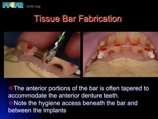 Tissue Bar Fabrication




v The anterior portions of the bar is often tapered to
accommodate the anterior denture teeth.
v Note the hygiene access beneath the bar and
between the implants
 