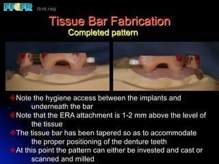 Tissue Bar Fabrication
                  Completed pattern




v Note the hygiene access between the implants and
        underneath the bar
v Note that the ERA attachment is 1-2 mm above the level of
        the tissue
v The tissue bar has been tapered so as to accommodate
        the proper positioning of the denture teeth
v At this point the pattern can either be invested and cast or
        scanned and milled
 