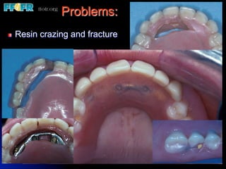 Problems:
!    Resin crazing and fracture
 