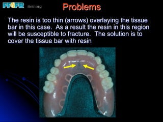 Problems
The resin is too thin (arrows) overlaying the tissue
bar in this case. As a result the resin in this region
will be susceptible to fracture. The solution is to
cover the tissue bar with resin
 