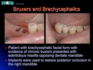 Bruxers and Brachycephalics




v  Patient with brachycephalic facial form with
    evidence of chronic buxism presented with
    edentulous maxilla opposing dentate mandible
v  Implants were used to restore posterior occlusion in
    the right mandible
 