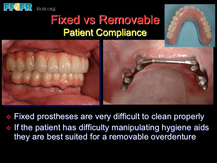 Edentulous Maxilla Overlay Dentures