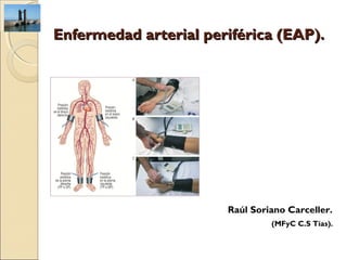 Enfermedad arterial periférica (EAP).




                       Raúl Soriano Carceller.
                                (MFyC C.S Tías).
 