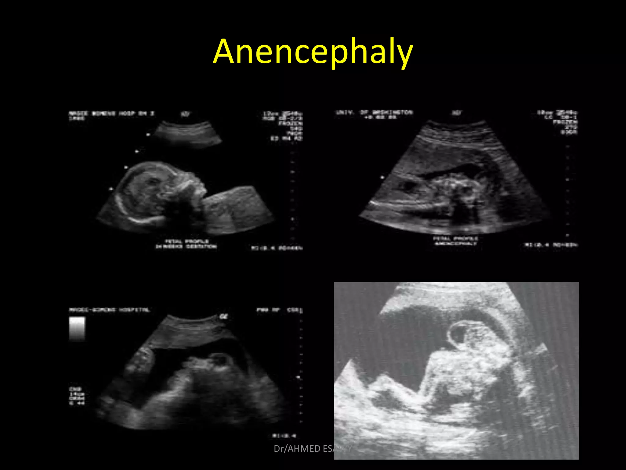 6 Fetal skull Dr Ahmed Esawy | PDF