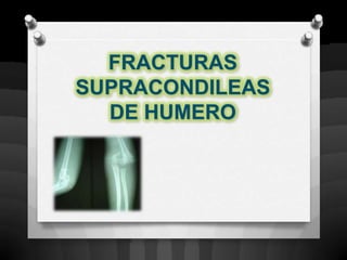 FRACTURAS
SUPRACONDILEAS
  DE HUMERO
 
