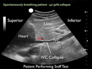 3 cm
Spontaneously breathing patient - 40-50% collapse
 