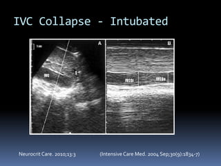 IVC Collapse - Intubated
Neurocrit Care. 2010;13:3 (Intensive Care Med. 2004 Sep;30(9):1834-7)
 