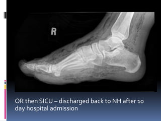 OR then SICU – discharged back to NH after 10
day hospital admission
 