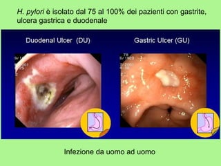 gastric ulcer.jpg H. pylori  è isolato dal 75 al 100% dei pazienti con gastrite, ulcera gastrica e duodenale Infezione da uomo ad uomo 