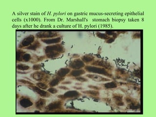 A silver stain of  H. pylori  on gastric mucus-secreting epithelial cells (x1000). From Dr. Marshall's  stomach biopsy taken 8 days after he drank a culture of H. pylori (1985).  