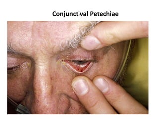Conjunctival Petechiae
 