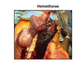 Hemothorax
 