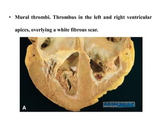 Thrombosis
 