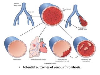 Mural thrombi.




Laminated thrombus in a dilated abdominal aortic
                  aneurysm.
 