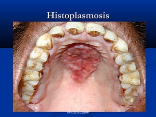 HistoplasmosisHistoplasmosis
APR-2015-CSBRP
 