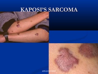 KAPOSI’S SARCOMAKAPOSI’S SARCOMA
APR-2015-CSBRP
 