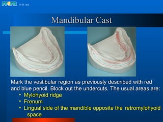 Mandibular Cast Mark the vestibular region as previously described with red and blue pencil. Block out the undercuts. The usual areas are: Mylohyoid ridge Frenum Lingual side of the mandible opposite the  retromylohyoid  space 