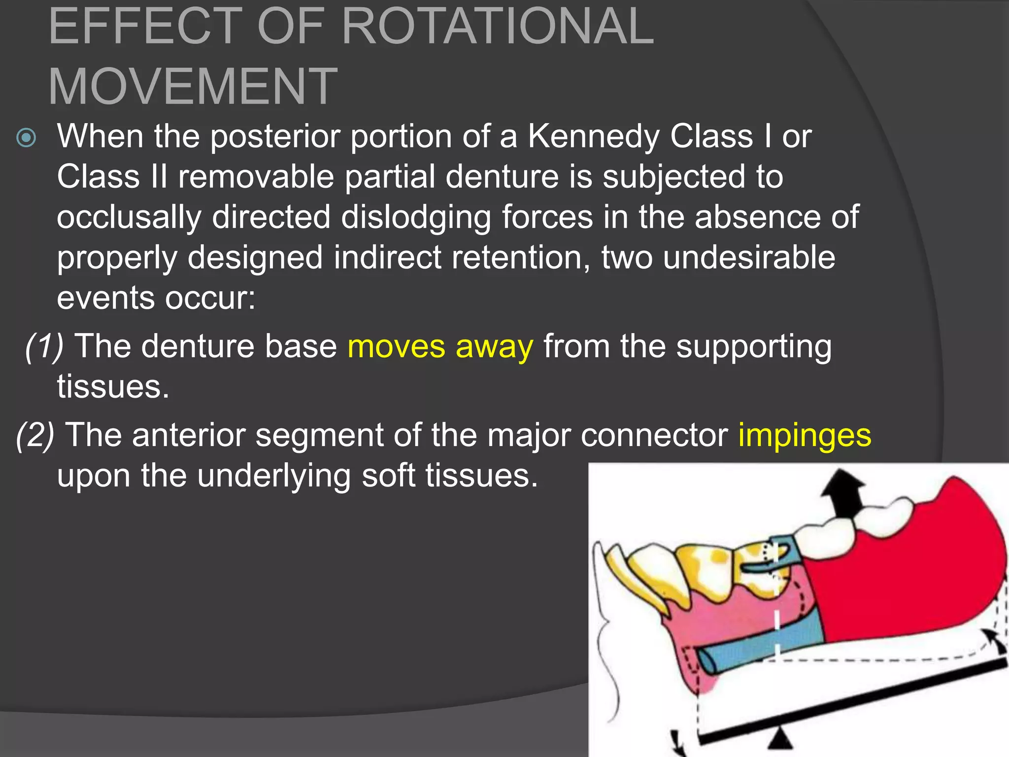 Rotational Rpd INDIRECT RETAINERS IN REMOVABLE PARTIAL DENTURES | PPTX